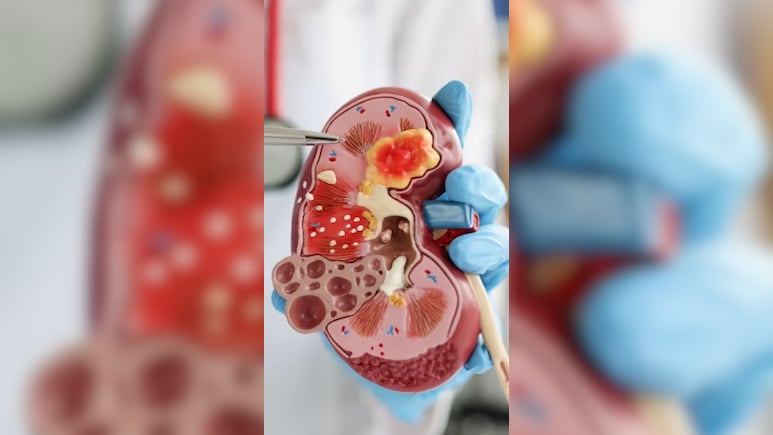 पथरी से डैमेज हो गई किडनी? डॉक्टर ने बताई टॉप 3 ड्रिंक्स