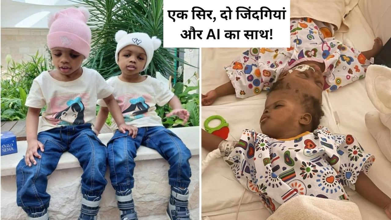 40 घंटे के ऑपरेशन और AI तकनीक ने दी दो सगी बहनों को नई जिंदगी, जिनके सिर आपस में जुड़े थे