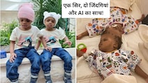 40 घंटे के ऑपरेशन और AI तकनीक ने दी दो सगी बहनों को नई जिंदगी, जिनके सिर आपस में जुड़े थे