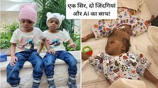 40 घंटे के ऑपरेशन और AI तकनीक ने दी दो सगी बहनों को नई जिंदगी, जिनके सिर आपस में जुड़े थे