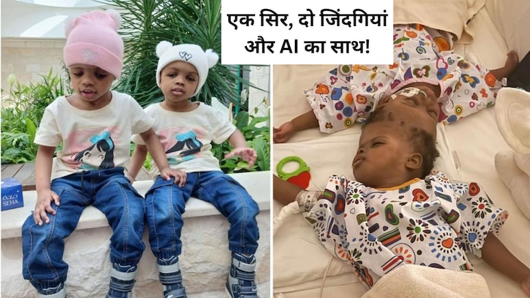 40 घंटे के ऑपरेशन और AI तकनीक ने दी दो सगी बहनों को नई जिंदगी, जिनके सिर आपस में जुड़े थे