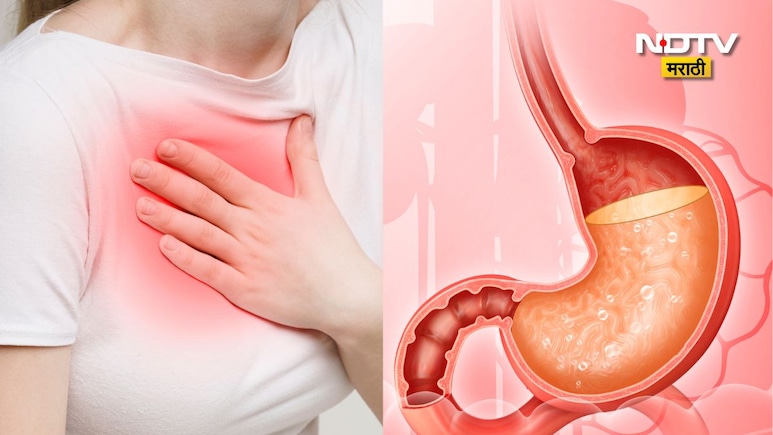 What Is Acidity: पोटात जळजळ होते? अ&zwj;ॅसिडिटी म्हणजे काय? तुमच्या या 7 वाईट सवयी तातडीने बंद करा, अन्यथा...