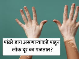 25व्या वर्षी अंगावर आले पांढरे डाग, हा आजार संसर्गजन्य? या समस्येपेक्षा लोकांचे वर्तन भयंकर? डॉक्टर म्हणाले...