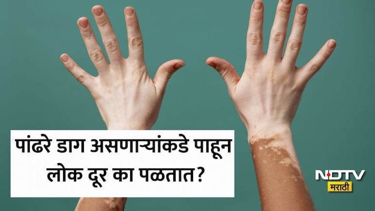 25व्या वर्षी अंगावर आले पांढरे डाग, हा आजार संसर्गजन्य? या समस्येपेक्षा लोकांचे वर्तन भयंकर? डॉक्टर म्हणाले...