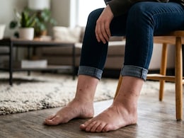 Swollen Feet And Tight Rings? Expert Explains The Surprising Reason Your Body Swells During Summer