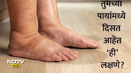 Burning Sensation In Feet: पायांची जळजळ आणि सूज येण्याकडे करू नका दुर्लक्ष, असू शकतो या गंभीर आजाराचा संकेत