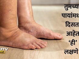 Burning Sensation In Feet: पायांची जळजळ आणि सूज येण्याकडे करू नका दुर्लक्ष, असू शकतो या गंभीर आजाराचा संकेत