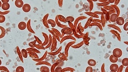 Madhya Pradesh Governor Calls For School-Based Screening Of Children For Sickle Cell Disease