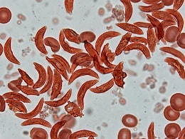 India's Sickle Cell Anemia Burden: Why Certain Regions And Communities Are More Affected