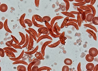 India's Sickle Cell Anemia Burden: Why Certain Regions And Communities Are More Affected