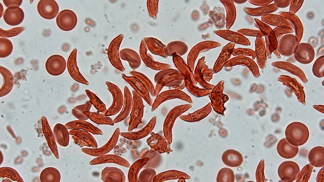 Sickle Cell Disease is especially common in certain tribal and rural populations