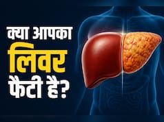 AIIMS डॉक्टर ने बताए फैटी लिवर से जुड़े 3 म‍िथ्‍स