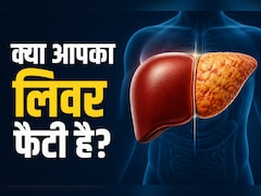AIIMS डॉक्टर ने बताए फैटी लिवर से जुड़े 3 म‍िथ्‍स