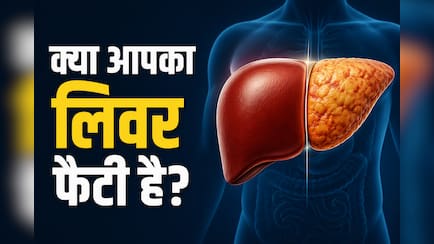 AIIMS डॉक्टर ने बताए फैटी लिवर से जुड़े 3 म‍िथ्‍स