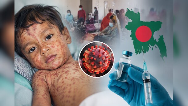 बांग्लादेश में खसरे का कहर, 750 बच्चों की मौत, 1 लाख से ज्यादा बीमार, जानें इसके शुरुआती लक्षण और बचाव