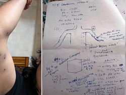 "Pellet Shards Stuck To Skin": Hospital Report Contradicts Delhi Police Claim
