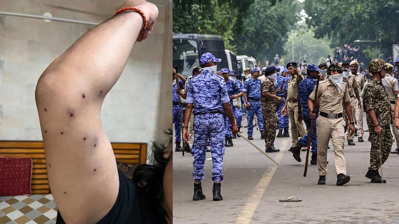 "Saw Cop Pointing His Pellet Gun At Me": Man Injured In CJP Protest To NDTV