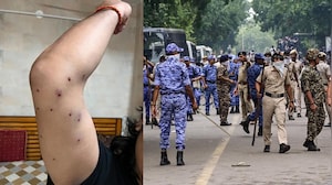 "Saw Cop Pointing His Pellet Gun At Me": Man Injured In CJP Protest To NDTV