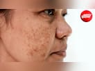 चेहरे पर पड़ रहे हैं जिद्दी काले दाग? एक्सपर्ट से जानिए पिगमेंटेशन के पीछे छिपी असली वजहें