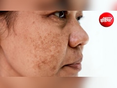 चेहरे पर पड़ रहे हैं जिद्दी काले दाग? एक्सपर्ट से जानिए पिगमेंटेशन के पीछे छिपी असली वजहें