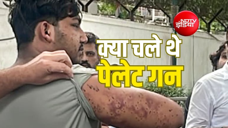 'पेलेट गन के छर्रे फंसे मिले', सफदरजंग अस्पताल की रिपोर्ट में CJP प्रदर्शनकारी पर पेलेट गन के इस्तेमाल का जिक्र