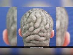दिमाग जैसी दिखने लगी थी सिर की त्वचा, 11 महीने तक चला 23 साल के युवक का इलाज और फिर...