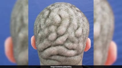 दिमाग जैसी दिखने लगी थी सिर की त्वचा, 11 महीने तक चला 23 साल के युवक का इलाज और फिर...