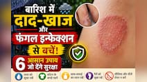 बारिश में दाद, खाज और फंगल इन्फेक्शन से हैं परेशान? इन आसान उपायों से करें बचाव