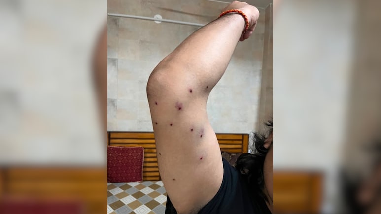 "Saw Cop Pointing His Pellet Gun At Me": Man Injured In CJP Protest To NDTV