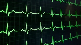 FDA Approves First-Ever AI Tool To Detect Hidden Heart Conditions Before Symptoms Show