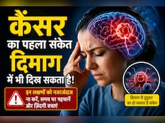 कैंसर का पहला संकेत दिमाग में भी दिख सकता है! डॉक्टर ने बताए Paraneoplastic Syndrome के चेतावनी वाले लक्षण