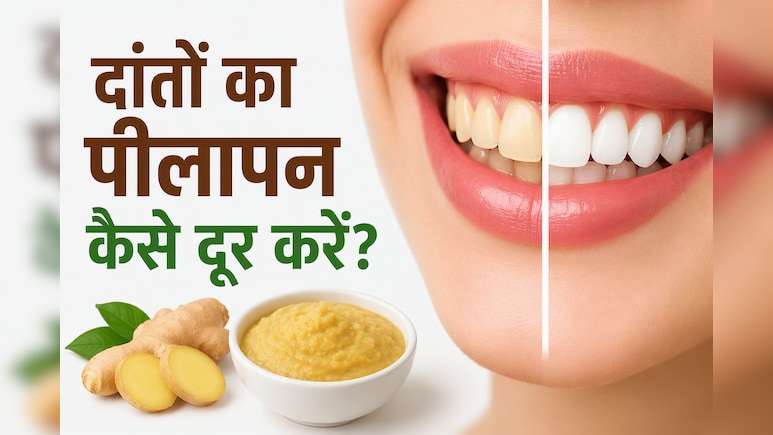 पीले दांतों की सफाई के लिए 5 मिनट का घरेलू उपाय, आयुर्वेदाचार्य ने बताए फायदे