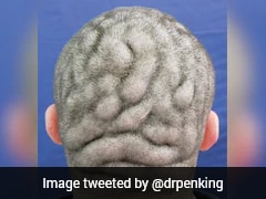 Man With Rare Brain-Like Scalp Condition Gets Life-Changing Plastic Surgery