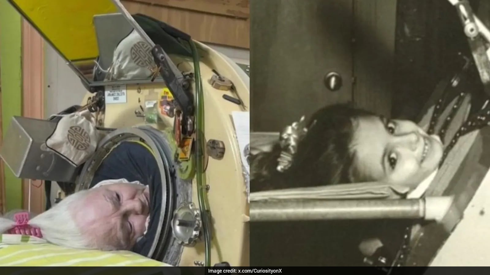Martha Lillard, Last US Polio Patient Using Iron Lung, Dies At 78