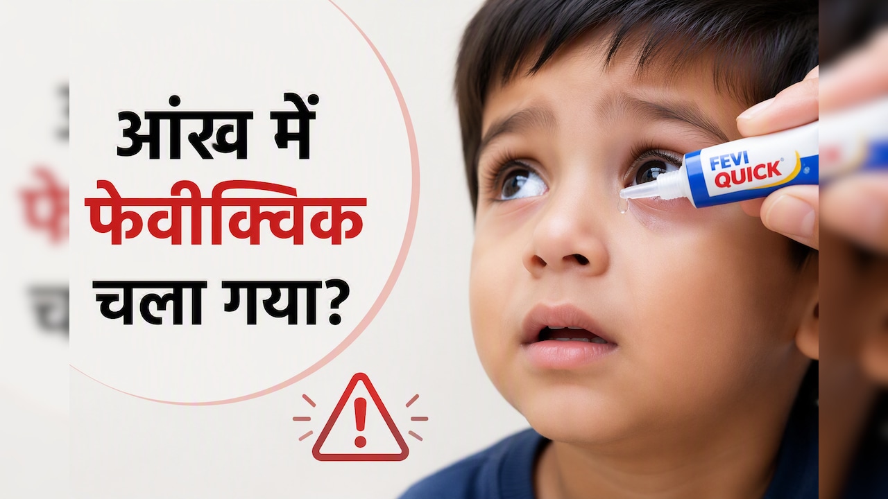 बच्चे की आंख में गलती से Feviquick चला जाए तो क्या करें? डॉक्टर ने बताया तुरंत उठाएं ये कदम