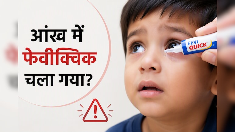 बच्चे की आंख में गलती से Feviquick चला जाए तो क्या करें? डॉक्टर ने बताया तुरंत उठाएं ये कदम