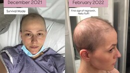 Breast Cancer Survivor Shares What Her Hair Looks Like After Chemotherapy