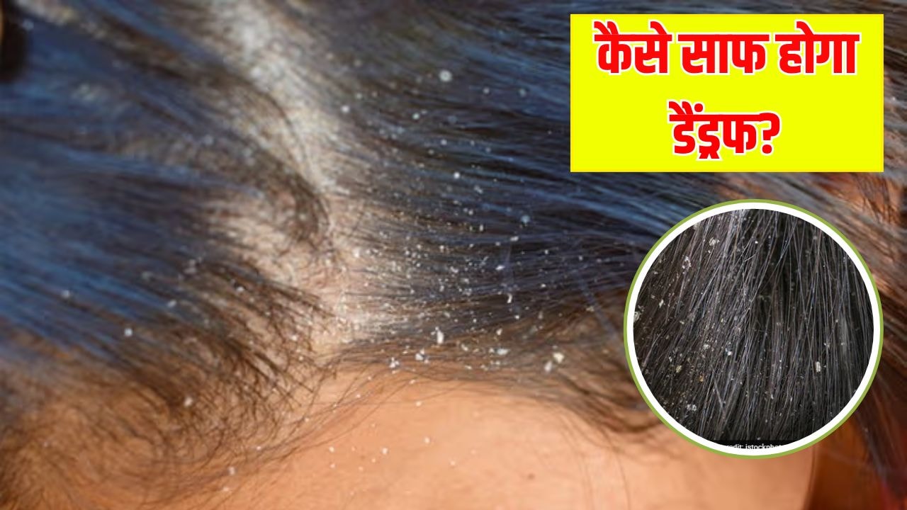 बार-बार वापस आ जाता है डैंड्रफ? डर्मेटोलॉजिस्ट ने बताया इस एक चीज से हो जाएगा जड़ से साफ