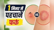 मैं 2 हफ्ते तक इसे मच्छर का काटना समझता रहा, आखिर में निकला फंगल इंफेक्शन
