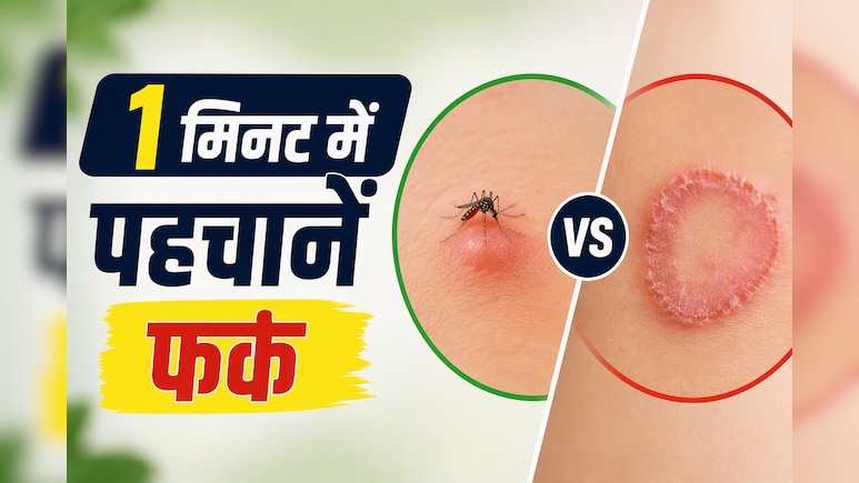 मैं 2 हफ्ते तक इसे मच्छर का काटना समझता रहा, आखिर में निकला फंगल इंफेक्शन&nbsp;
