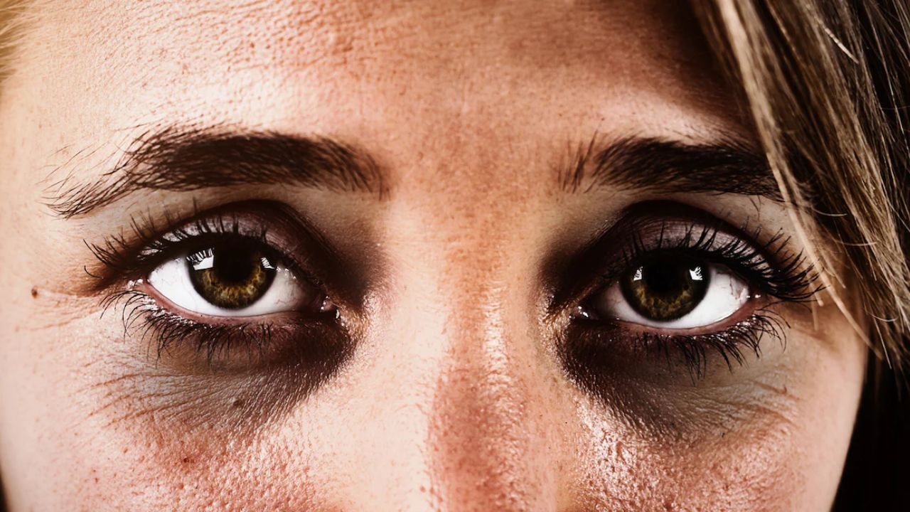 क्या रात में ज्यादा सोने से Dark Circles ठीक हो सकते हैं? स्किन की डॉक्टर से जानें कैसे लाइट होंगे आंखों के नीचे पड़े काले गड्ढे