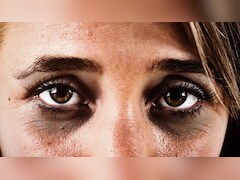 क्या रात में ज्यादा सोने से Dark Circles ठीक हो सकते हैं? स्किन की डॉक्टर से जानें कैसे लाइट होंगे आंखों के नीचे पड़े काले गड्ढे