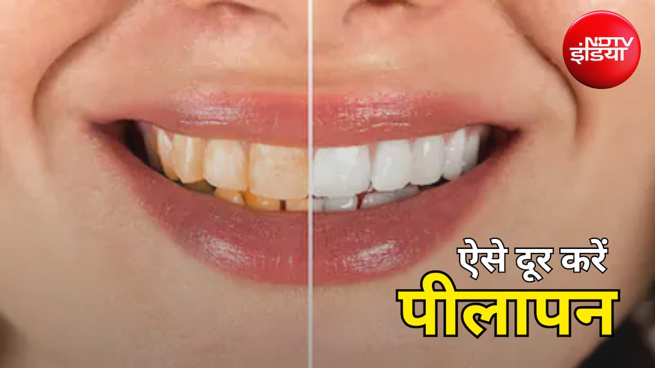 Teeth Whitening Tips: लाइफस्टाइल में बदलाव कर अपनाएं ये घरेलू उपाय, मोती जैसे चमकेंगे दांत और दूर होगा पीलापन