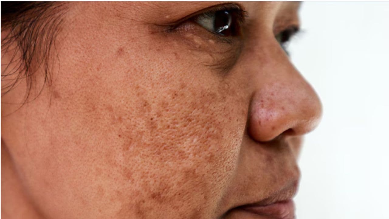 चेहरे पर झाइयों को कम करने के लिए क्या करें? Dermatologist से जानें क्या करने से धीरे-धीरे साफ होने लगेगी स्किन