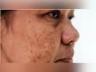 झाइयों को कम करने के लिए क्या करें? Dermatologist से जानें क्या करने से धीरे-धीरे साफ होने लगेगी स्किन