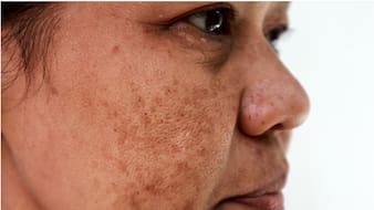 झाइयों को कम करने के लिए क्या करें? Dermatologist से जानें क्या करने से धीरे-धीरे साफ होने लगेगी स्किन