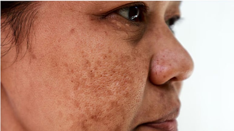 चेहरे पर झाइयों को कम करने के लिए क्या करें? Dermatologist से जानें क्या करने से धीरे-धीरे साफ होने लगेगी स्किन