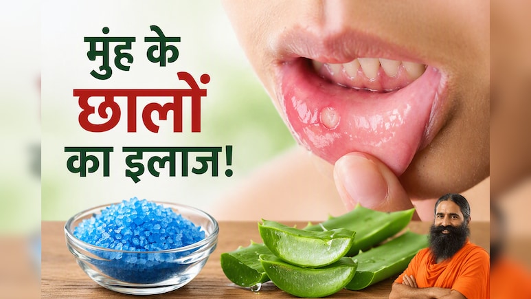 मुंह के छालों से हैं परेशान? बाबा रामदेव ने बताया 2 मिनट का देसी नुस्खा