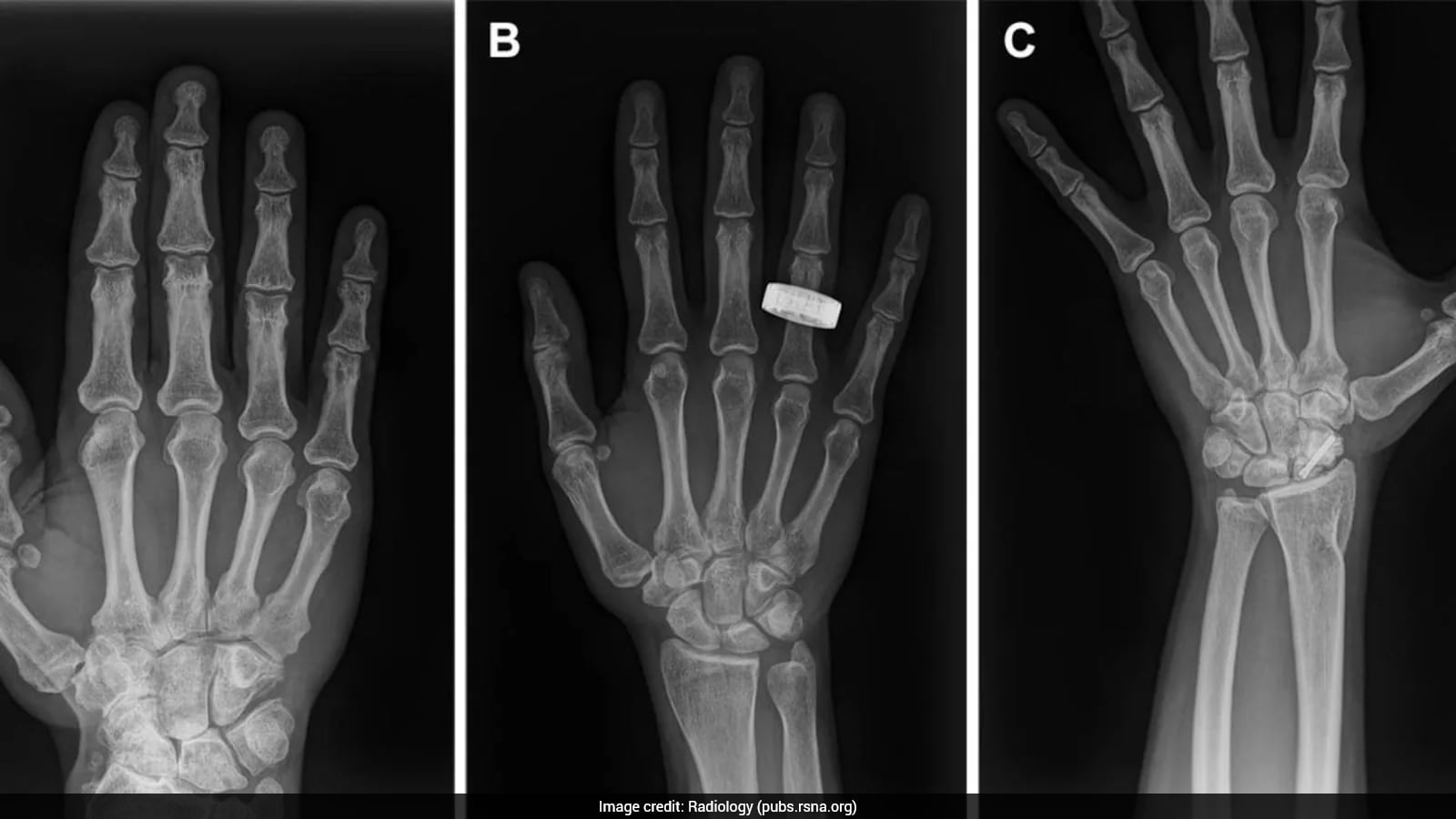 First Human X-Rays Captured In Space Mark Major Breakthrough For Astronaut Health - NDTV image
