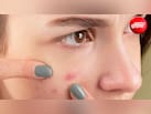 क्या हर पिंपल पर असरदार होते हैं Pimple Patch? डर्मेटोलॉजिस्ट से जानिए कैसे करें इस्तेमाल